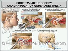 Tmj Right Arthroscopy With Manipulation Female Tmj Temporomandibular Joint Manipulation