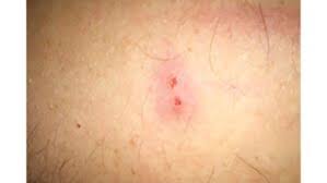 Image result for wolf spider bite skin