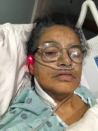 First pic is from cancer treatment and 2nd pic from stroke