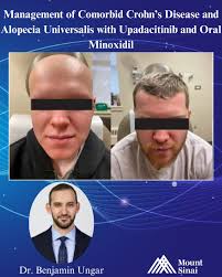 Dr. Emma Guttman gives expert advice in Self magazine online. “Can you  Prevent Hair Loss Before It's Too Late?” Time is of the essence, advises  Dr. Guttman. Details: https://bit.ly/HairLoss_Selfmag The Mount Sinai