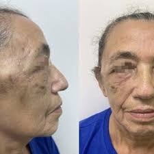 The drawing compares the previously described McGregor technique (A)...