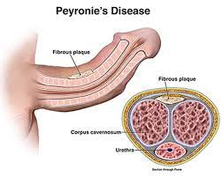 The treatment of skin plaques depends upon the treatment of the underlying skin disease. Peyronie S Disease Causes Diagnosis Treatment