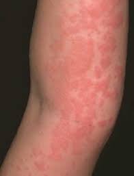 Yikes Caffeine Allergies Are Way More Common Than I Thought Home Remedies For Allergies Skin Allergies Natural Remedies For Allergies