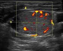 Throat cancer is often easily seen by an ent exam. Non Thyroid Cystic Masses Identified On Neck Ultrasound