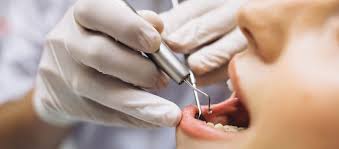 Maven Dental Cannon Hill Brisbane ...