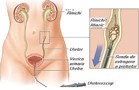 Se pare ca la romani mai prinde si operatia de micsorare a stomacului, cunoscuta sub numele de gastric sleeve. Http Www Despreboli Ro Boli De Rinichi 2014 Tratament Litiaza Renala 3239