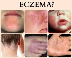 Ini adalah contoh psoriasis,kalau psoriasis ini manusia,mesti saya hentam dia sampai lumat,sungguh teruk dia buat hidup saya sungguh merana. Berkesan Penyakit Ekzema Dan Psoriasis Sembuh Dengan Bedak Asmak