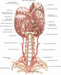 Carotid Artery Dissection Also Known As The Ticking Time Bomb Vertebral Artery Medical Anatomy Carotid Artery