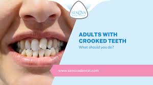 Can Invisalign Fix A Snaggle Tooth?