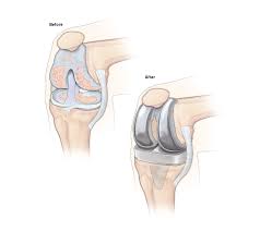 Take a step towards the chair. Knee Replacement Surgery Temple Health