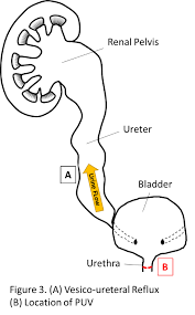 How significant are clinically insignificant residual fragments. My Baby Has Swollen Kidneys What Is Prenatal Hydronephrosis