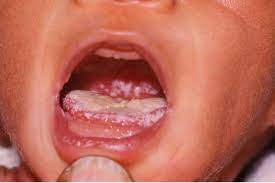 Although this is a naturally occurring and harmless organism in the mouth, the problem arises when it grows too much. Lidah Putih Pada Bayi Akibat Susu Atau Infeksi Jamur Ini Bedanya Medisweb