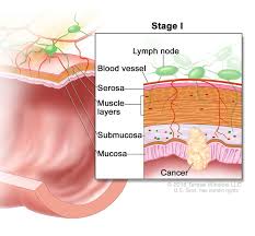 A symptom is something that only the person experiencing it can identify and describe, such as fatigue, nausea, or pain. Rectal Cancer Treatment Pdq Patient Version National Cancer Institute