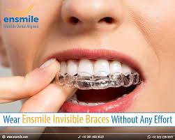 There are several factors to consider, so there's no single answer. How Much Does Cost On Invisible Braces In Lahore Invisible Dental Aligner In Lahore Pakistan