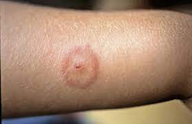 Praxis Sommer Was Sticht Denn Da Doctors Today