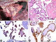 Check spelling or type a new query. Scielo Brasil Fatal Hemothorax Caused By Pleural Mesothelioma In A Lion Fatal Hemothorax Caused By Pleural Mesothelioma In A Lion