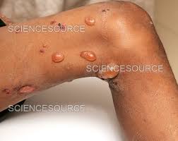 Image result for Pemphigus