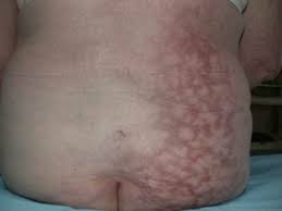 Eritema Ab Igne Chronic Heat Dermatitis Hot Water Bottle Rash Fire Stains Granny S Tartan Toasted Skin Syndrome Erythema A Calore Ephelis Ignealis