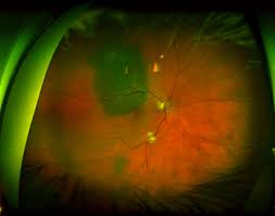 The optos® retinal screening is an important part of our routine eye exams. Ultra Widefield Imaging Can Enhance Efficiency For Practices