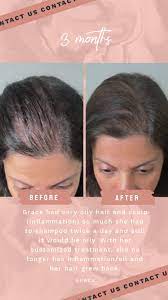 Thinning Hair And Hair Loss Hairstyles For Thin Hair Hair Loss Remedies Hair Loss Remedies Women