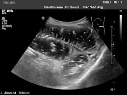 Darmverschluss (ileus) ein darmverschluss oder ileus ist eine lebensgefährliche akute darmerkrankung. Ultraschall Des Darms Universitatsklinikum Ulm