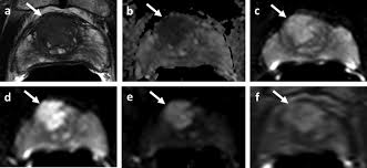 Novel radiotracers (e.g., acetate, flt fluorothymidine, facbc … Multiparametric Prostate Magnetic Resonance Imaging In The Evaluation Of Prostate Cancer Turkbey 2016 Ca A Cancer Journal For Clinicians Wiley Online Library