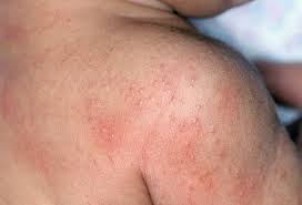 Beberapa gejala dan tanda penyakit akibat infeksi virus hiv pada tubuh manusia dapat muncul dan dirasakan oleh tubuh odha (orang dengan hiv aids) bahkan ketika virus baru beberapa bulan menginfeksi tubuh. Agung Febnika Pengertian Hiv Dan Gejalanya