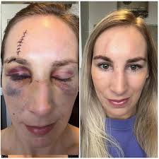 Internationally ranked muay fighter's LED light therapy results