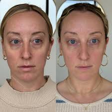 Look at us being all bada$$ with our fancy new skills! Yesterday, I was  fortunate enough to be trained by an amazing specialist Aesthetic  Sonographer, Candice Dery @aesthetic_imaging (shout out for organizing, @