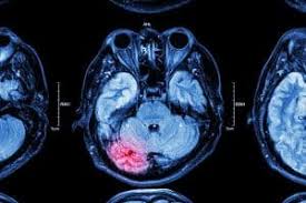 Image result for Diffuse Axonal Injury