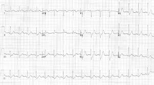 Stemi results from complete and prolonged occlusion of an epicardial coronary blood vessel and is defined based on ecg criteria.nstemi usually results from severe coronary artery narrowing, transient. Myocardial Ischaemia Litfl Ecg Library Diagnosis