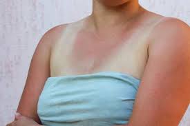 Kulit terbakar dapat menjadi kondisi gawat darurat yang membahayakan nyawa atau hanya masalah medis sepele. Kenali Perbedaan Antara Alergi Matahari Sun Rashes Dan Terbakar Matahari Sunburn Alodokter