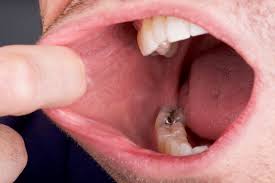 Mouth cancer (also known as oral cancer) can occur anywhere inside your mouth — in your lips, gums, tongue, under your tongue, on the roof of your mouth, inside your cheeks and around your wisdom teeth. Oral Cancer Prevention Bowen Family Dentistry Manhatttan Ks