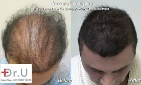 Dr Umar Hair Transplant Archives Hairsite Com