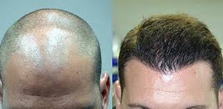 +1000€ · autotrapianto capelli + sopracciglia: Risparmiare Sul Trapianto Di Capelli E Possibile Generazione 850 Euro