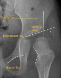 Image result for Hip XRay
