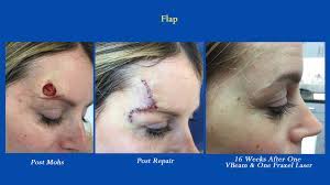 Mohs surgery pictures here show how effective the procedure can be and what to expect after recovery.read some stories before considering having the surgery. Mohs Surgery Nyc Laser Skin Surgery Nyc Skin Cancer Treatment
