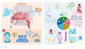 Image result for Epistaxis