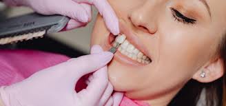 Veneers in White Rock & South Surrey