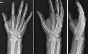 Image result for Lunate Dislocation