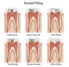 3 Things That Can Damage Your Dental Fillings Greenspoint Dental Houston Dentist