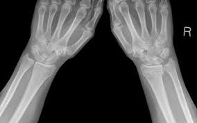 How long does bone healing take? Physical Therapy After A Broken Elbow What To Expect