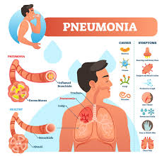 Pneumonia // mayo clinic, 2020. Pneumonia Medictests