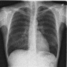 This chest x-ray is lacking in detail because of the noise that causes this blurry effect.