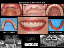 Teeth In One Day All On Four Dental Implants In Vancouver Burnaby Bc