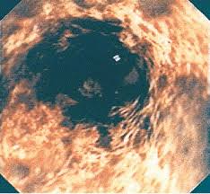 Herpes esophagitis in healthy adults and adolescents: Black Esophagus Associated With Herpes Esophagitis Gastrointestinal Endoscopy
