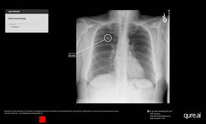 Image result for lung cancer xray