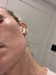 Image result for demodex rosacea