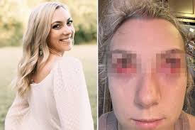 I had 'zombie' eyes, was blind after botched lash extensions