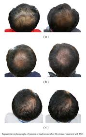 You can apply evening primrose oil directly to the scalp and hair. Pumpkin Seed Oil For Hair Growth A Scientific Review Hairguard